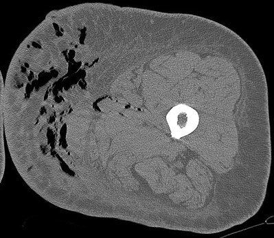 Figure 3 for case Necrotizing fasciitis ( RID3447 )